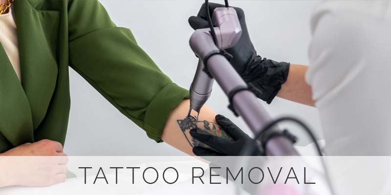 Tattoo-Removal